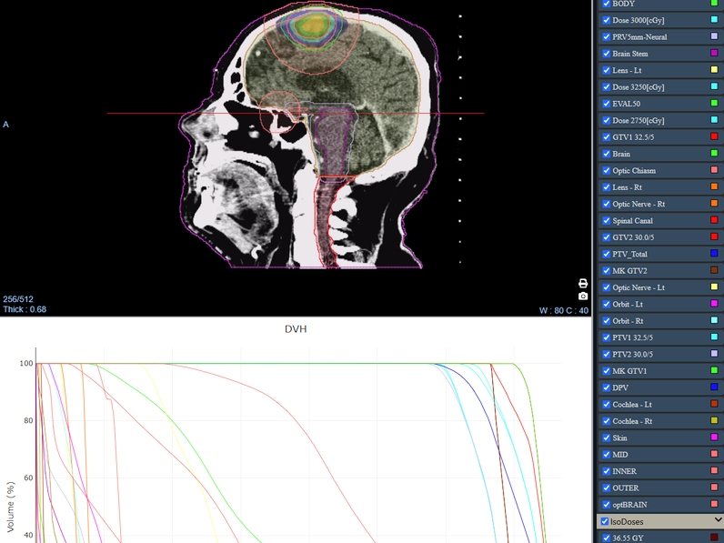 3D volume-rendered coronary CTA with a curved planar reformat and stenosis measurement overlay